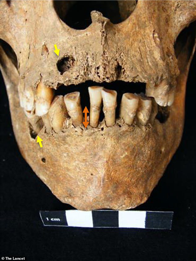 Aunque los arqueólogos no sabían que los restos estaban plagados de enfermedades, el cráneo presenta marcas como dientes más grandes que el promedio y una infección grave de las encías que dañó los tejidos blandos de su boca antes de morir.